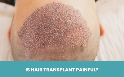 Is Hair Transplant Painful?