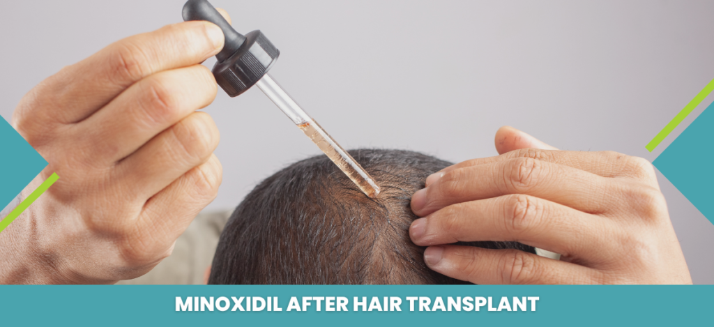 Person applying a liquid dropper to the scalp after a hair transplant, with the caption about minoxidil use.