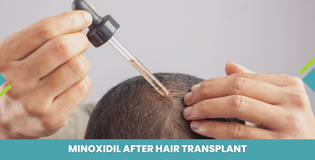 Person applying a liquid dropper to the scalp after a hair transplant, with the caption about minoxidil use.