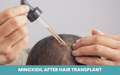 Minoxidil After Hair Transplant: When to Start, How to Use and What to Expect