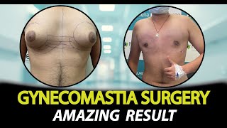 y8w4XdbAuYU-MQ Before and after gynecomastia surgery on a male chest, showing two circular insets and bold caption 'GYNECOMASTIA SURGERY AMAZING RESULT'.